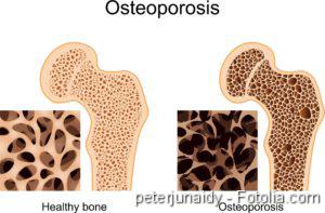 Osteoporose, Glukokortikoid-Therapie, Osteoporose, Knochenschwund, Osteoporosis